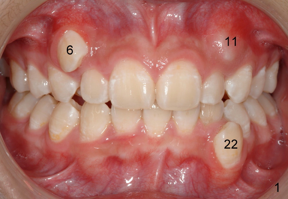 Canine extraction for ortho, Dental Education Lecture